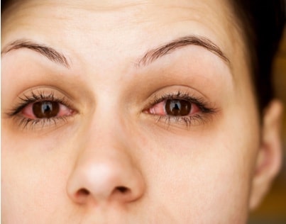 Allergies Oculaires Symptomes Causes Et Prevention Aerius